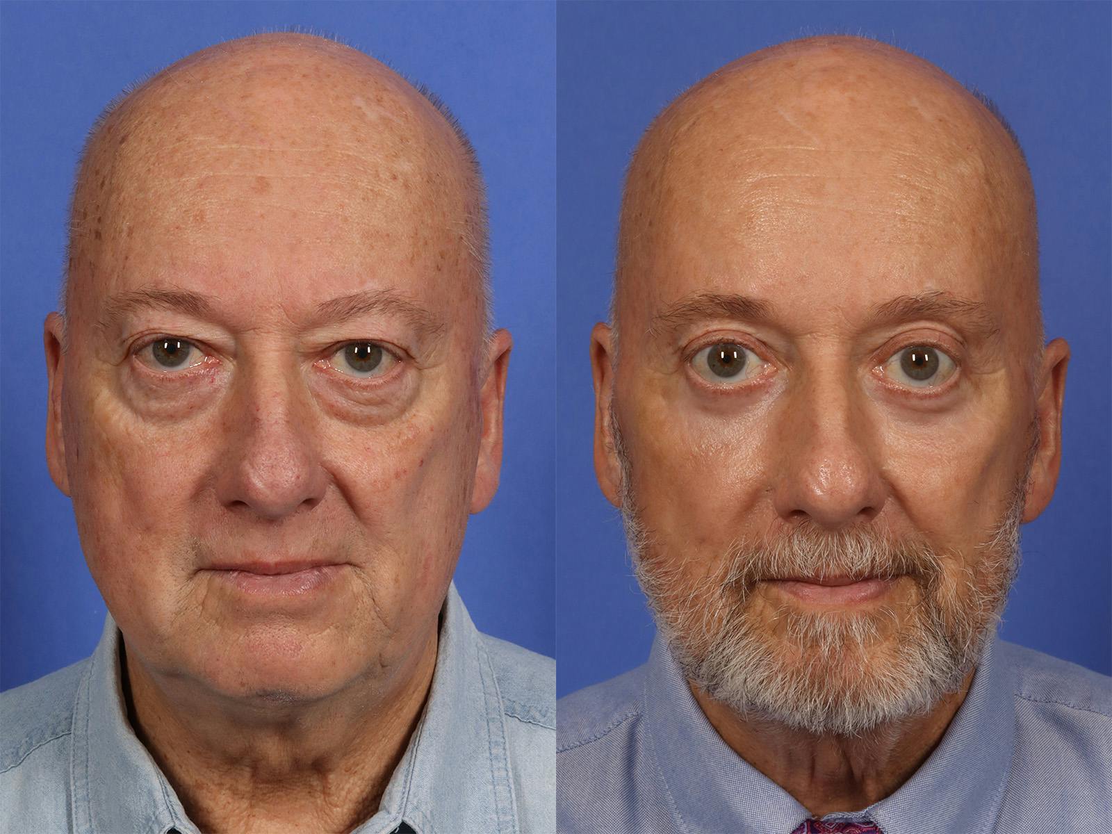 Liposculpture Before & After Gallery - Patient 254724 - Image 1