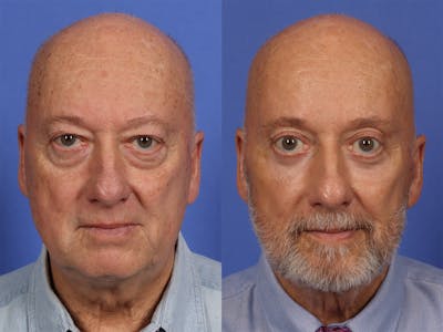 Liposculpture Before & After Gallery - Patient 254724 - Image 1