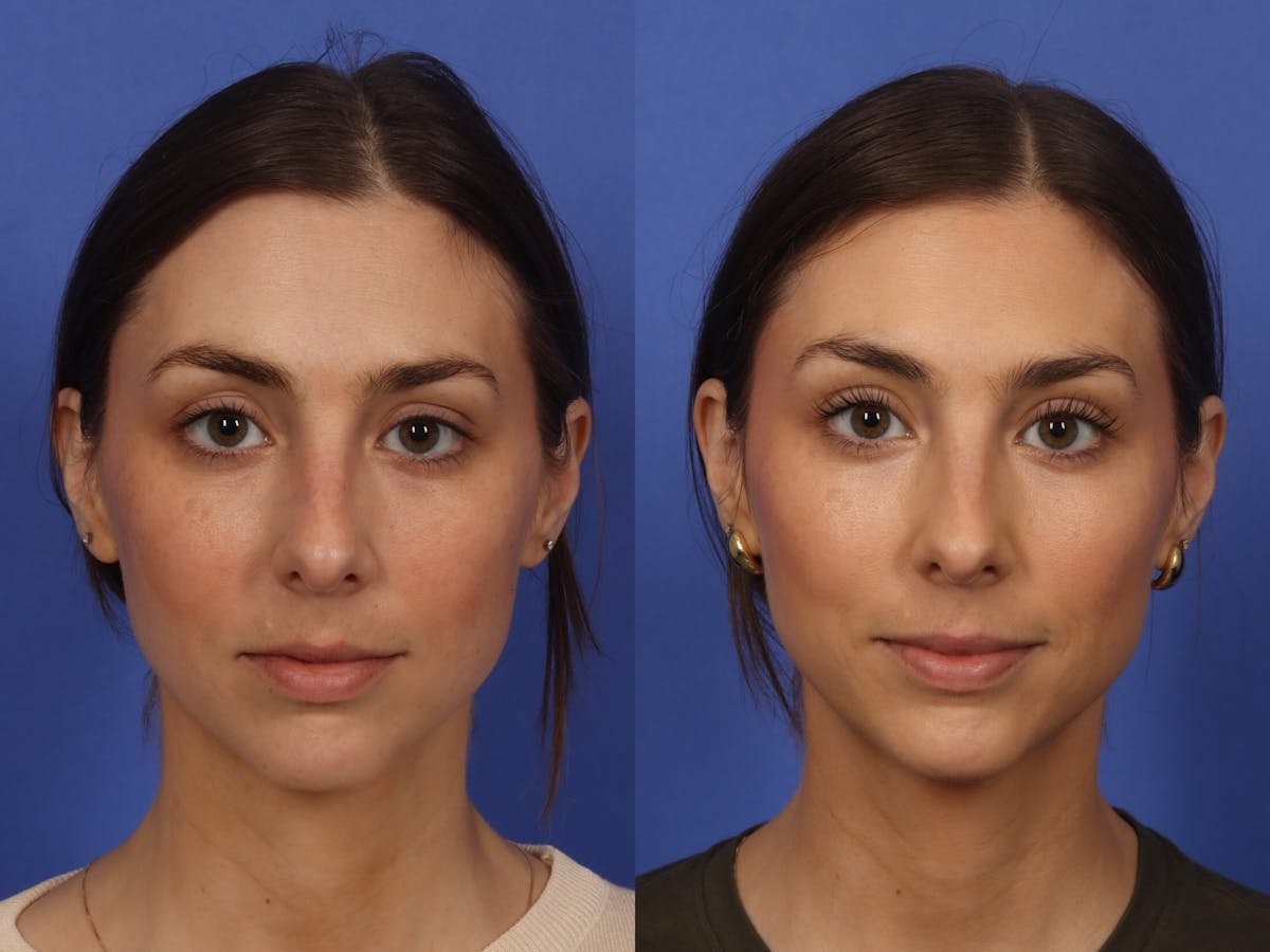 BOTOX® Before & After Gallery - Patient 215448 - Image 2