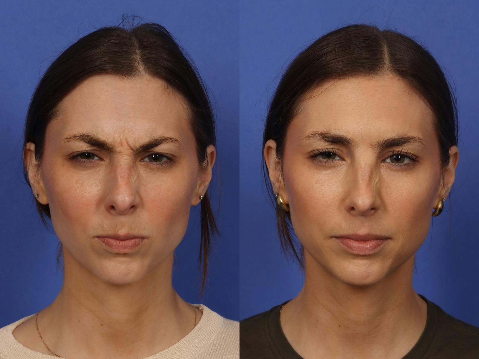 BOTOX® Before & After Gallery - Patient 215448 - Image 3
