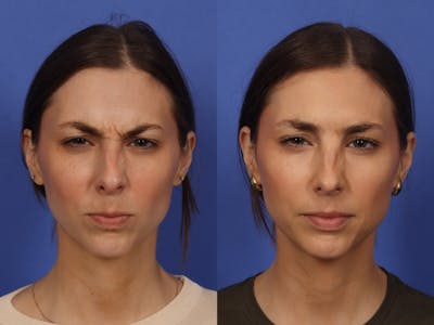 BOTOX® Before & After Gallery - Patient 215448 - Image 3