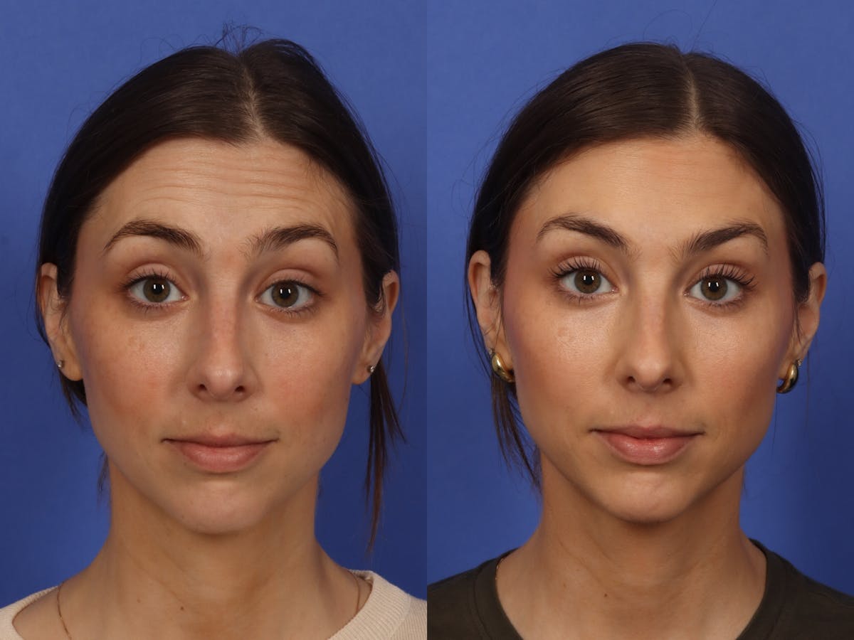 BOTOX® Before & After Gallery - Patient 215448 - Image 1