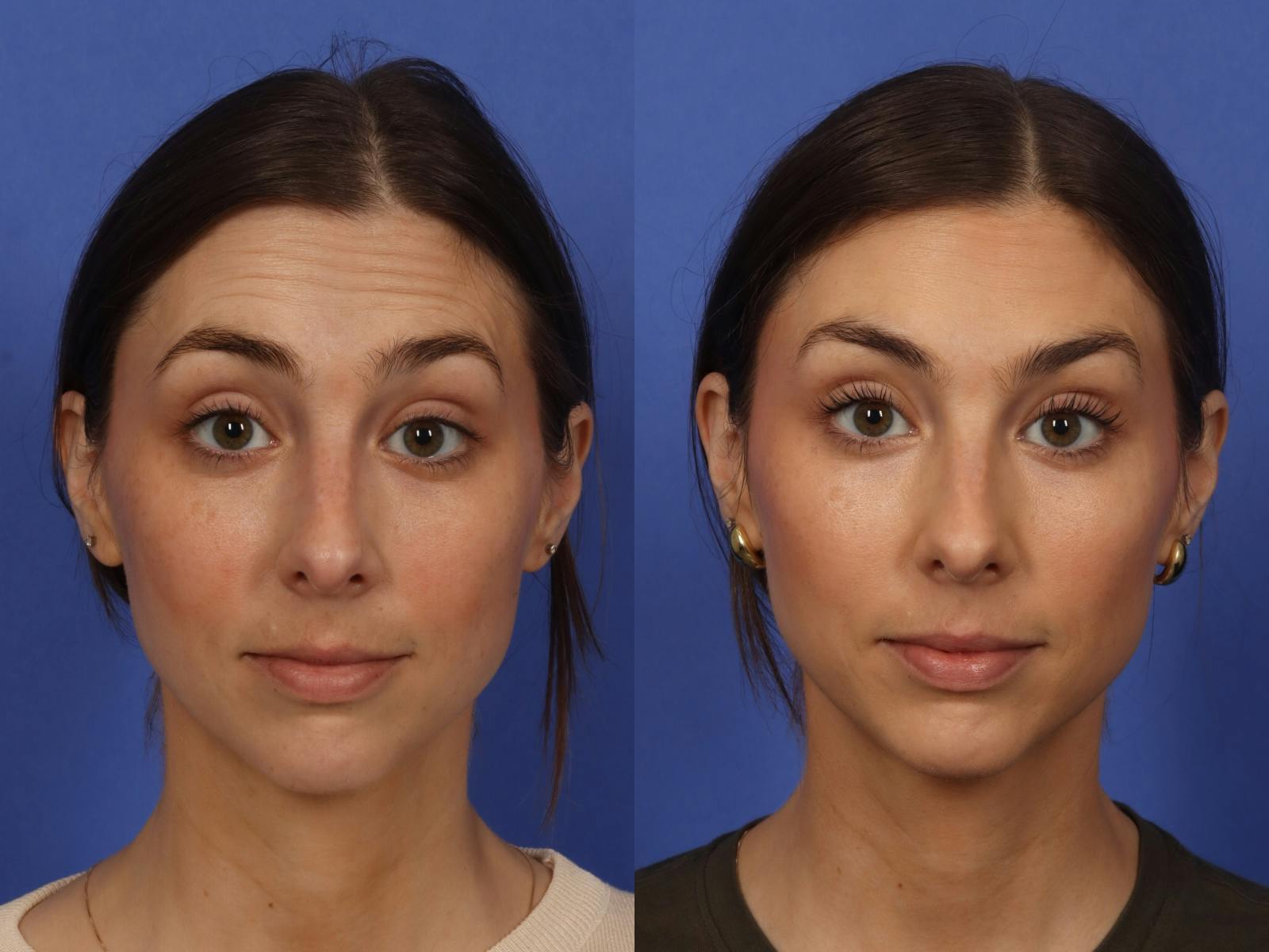 BOTOX® Before & After Gallery - Patient 215448 - Image 1