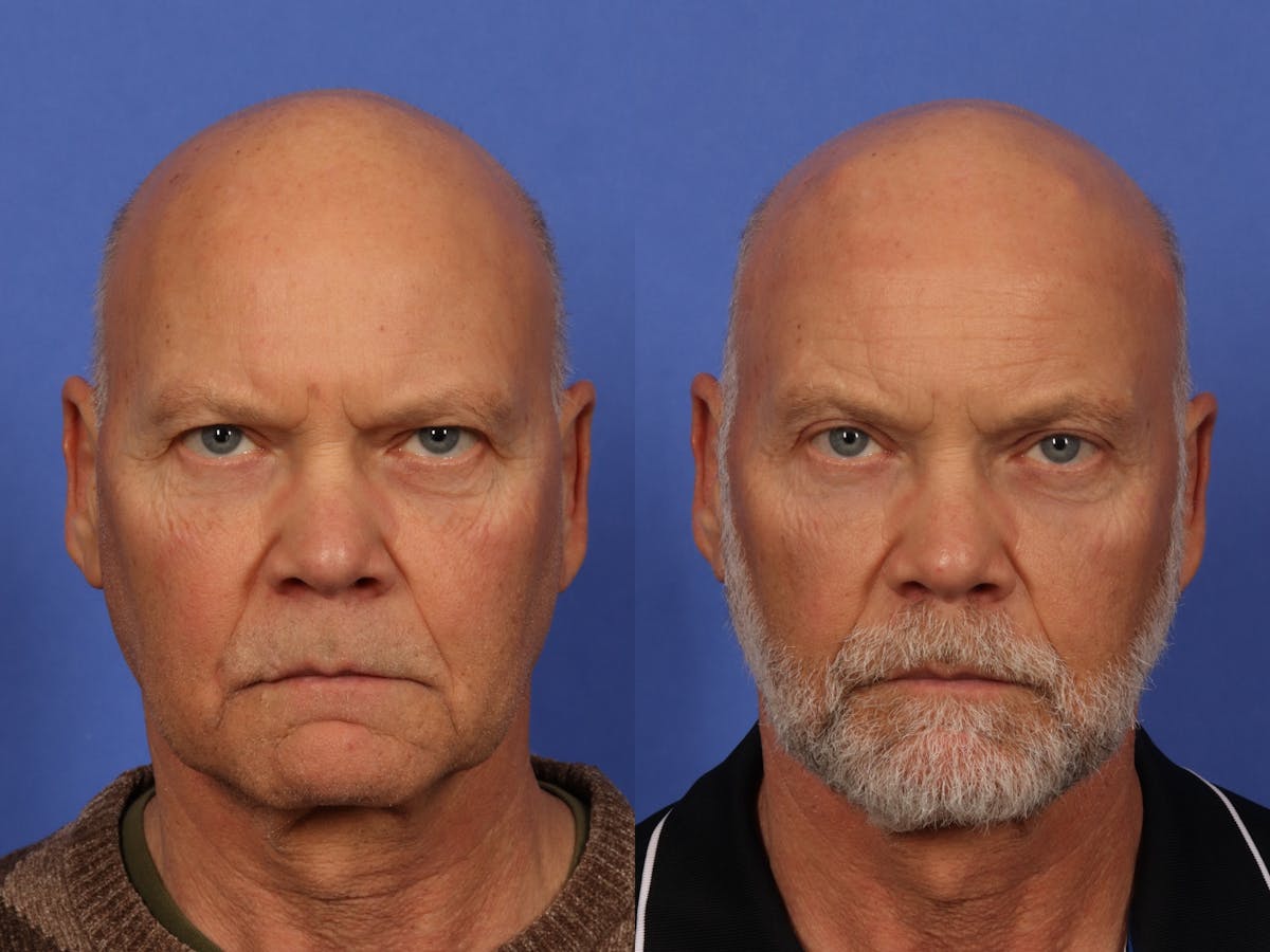 Brow Lift Before & After Gallery - Patient 261756 - Image 1