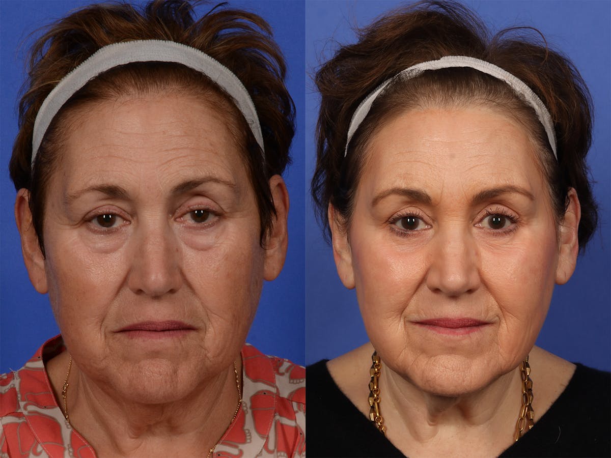 Liposculpture Before & After Gallery - Patient 218506 - Image 1