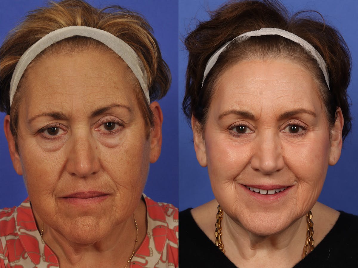 Liposculpture Before & After Gallery - Patient 218506 - Image 2