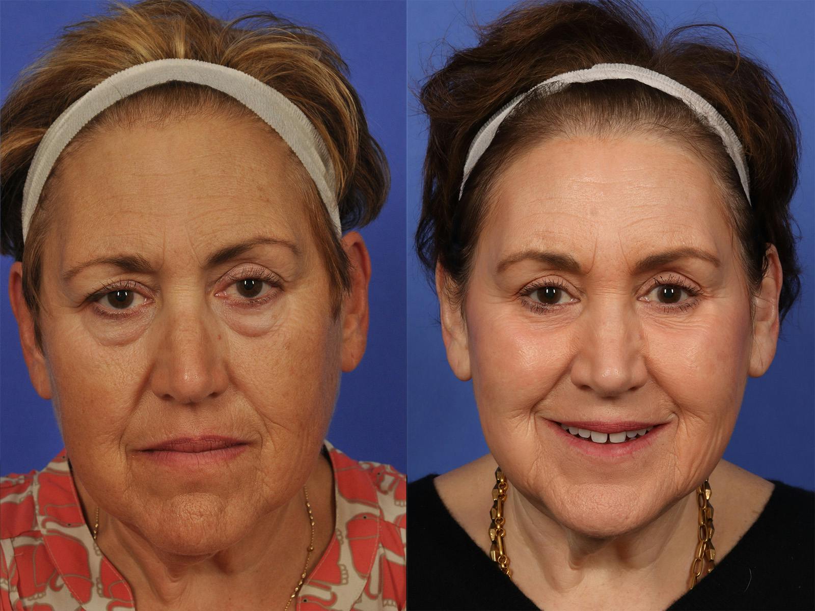 Liposculpture Before & After Gallery - Patient 218506 - Image 2