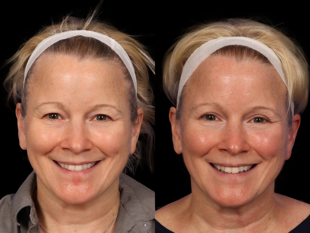 Eyelid Revision Surgery Before & After Gallery - Patient 339004 - Image 1