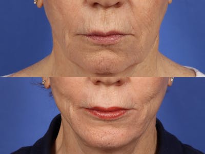 Hetter Peel Before & After Gallery - Patient 150959 - Image 1