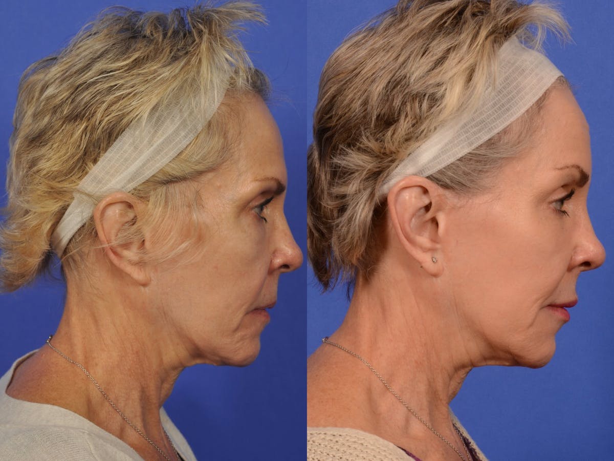 Brow Lift Before & After Gallery - Patient 316805 - Image 4