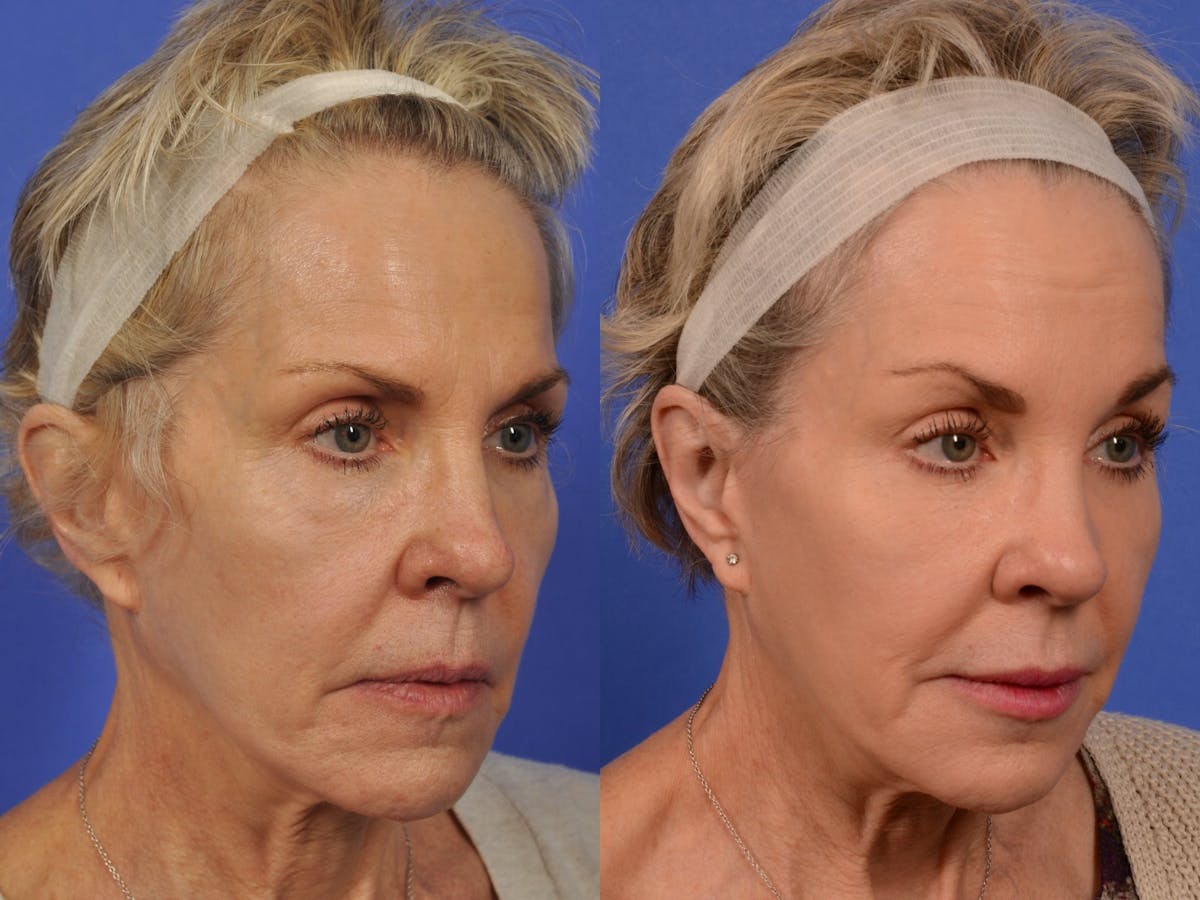 Brow Lift Before & After Gallery - Patient 316805 - Image 3