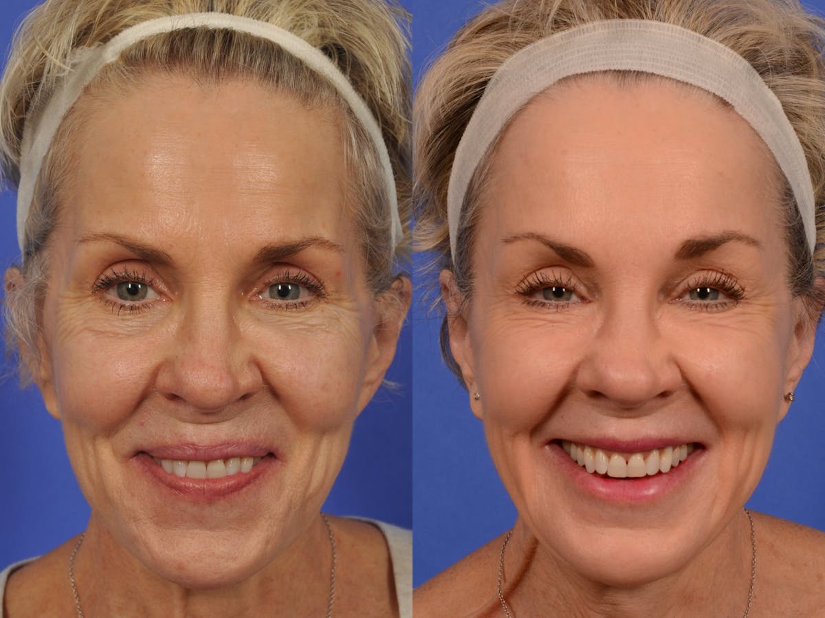 Brow Lift Before & After Gallery - Patient 316805 - Image 2