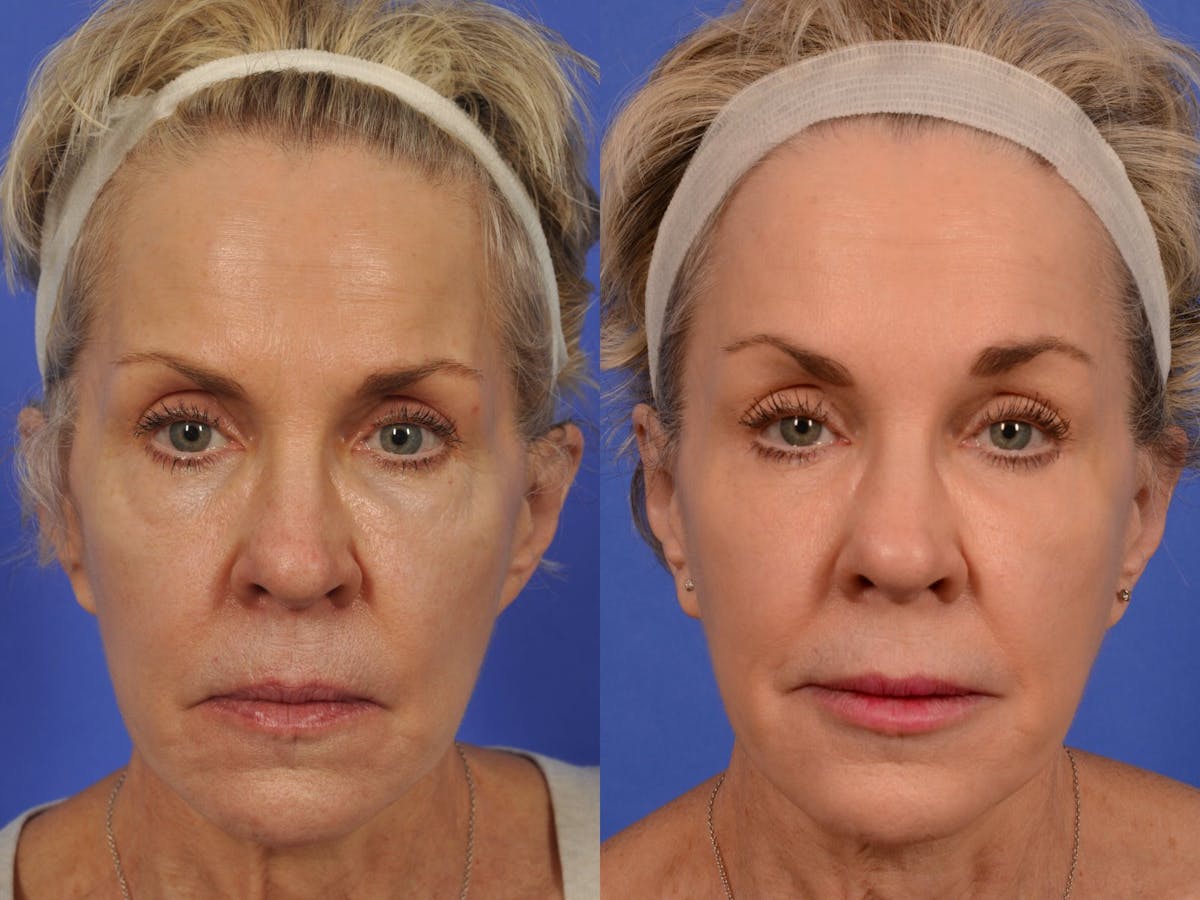 Brow Lift Before & After Gallery - Patient 316805 - Image 1
