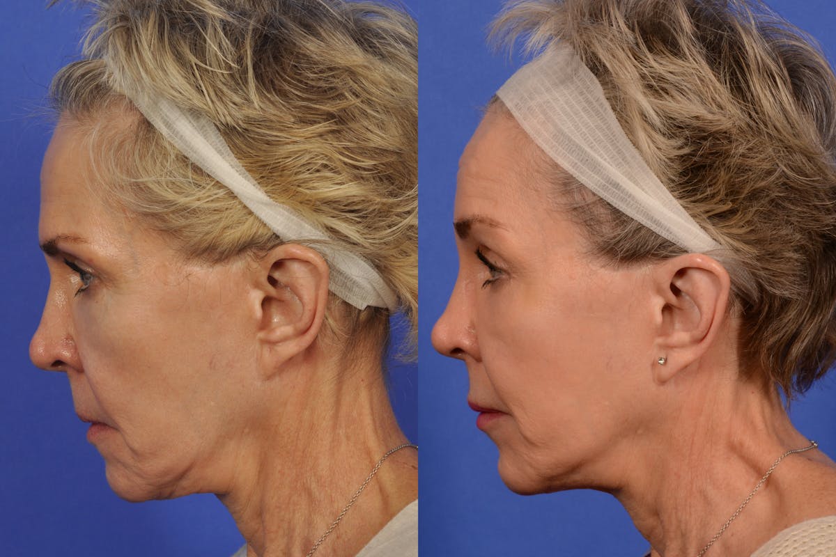 Brow Lift Before & After Gallery - Patient 316805 - Image 5