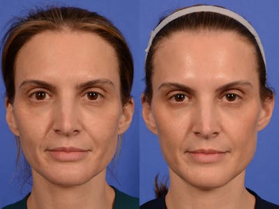 Sculptra Before & After Gallery - Patient 876607 - Image 1