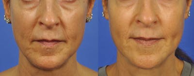 Sculptra Before & After Gallery - Patient 109904 - Image 1