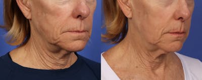 Sculptra Before & After Gallery - Patient 416251 - Image 3