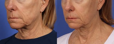 Sculptra Before & After Gallery - Patient 416251 - Image 2