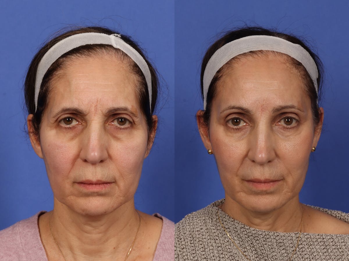 Liposculpture Before & After Gallery - Patient 275637 - Image 1
