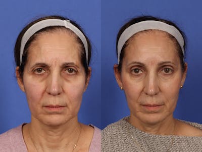 Liposculpture Before & After Gallery - Patient 275637 - Image 1