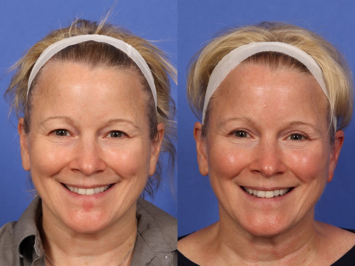 Eyelid Revision Surgery Before & After Gallery - Patient 339004 - Image 2
