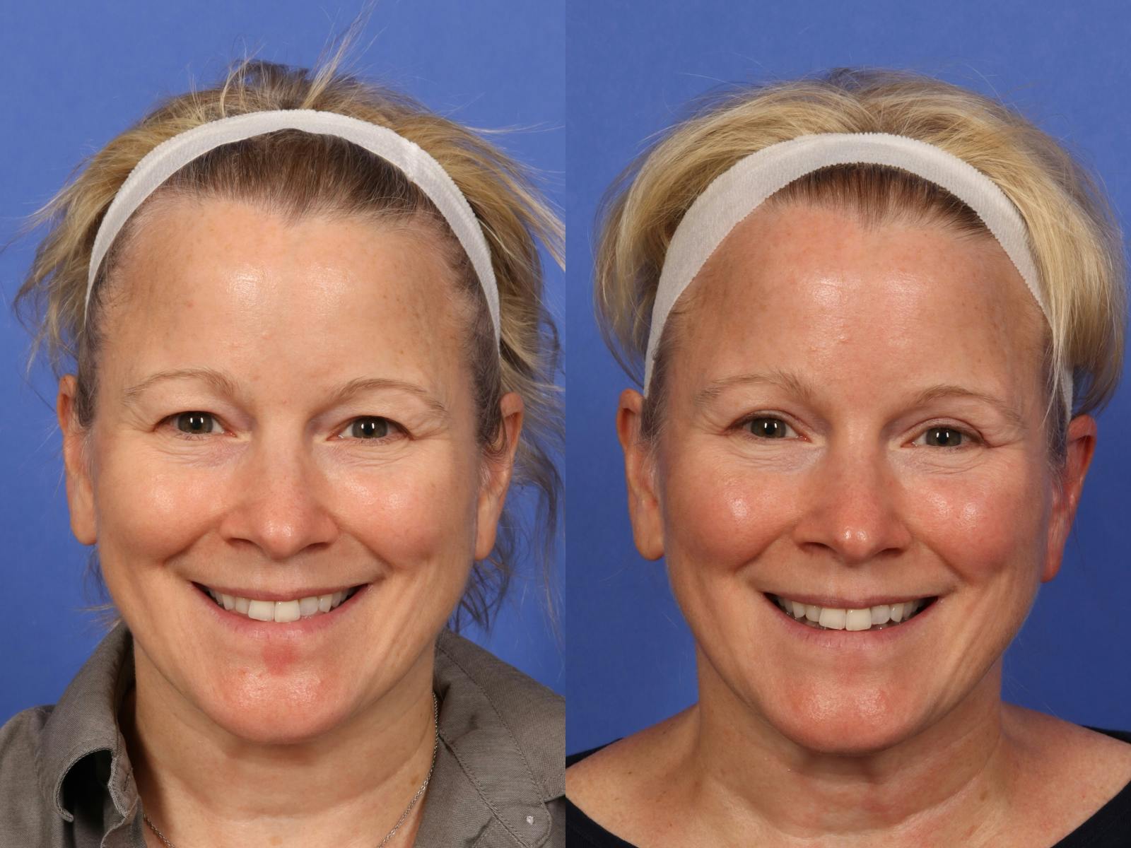 Eyelid Revision Surgery Before & After Gallery - Patient 339004 - Image 2