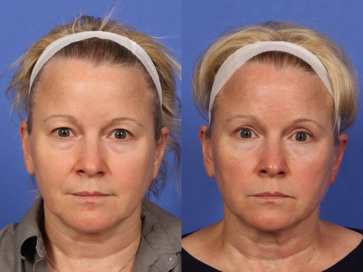 Eyelid Revision Surgery Before & After Gallery - Patient 339004 - Image 1