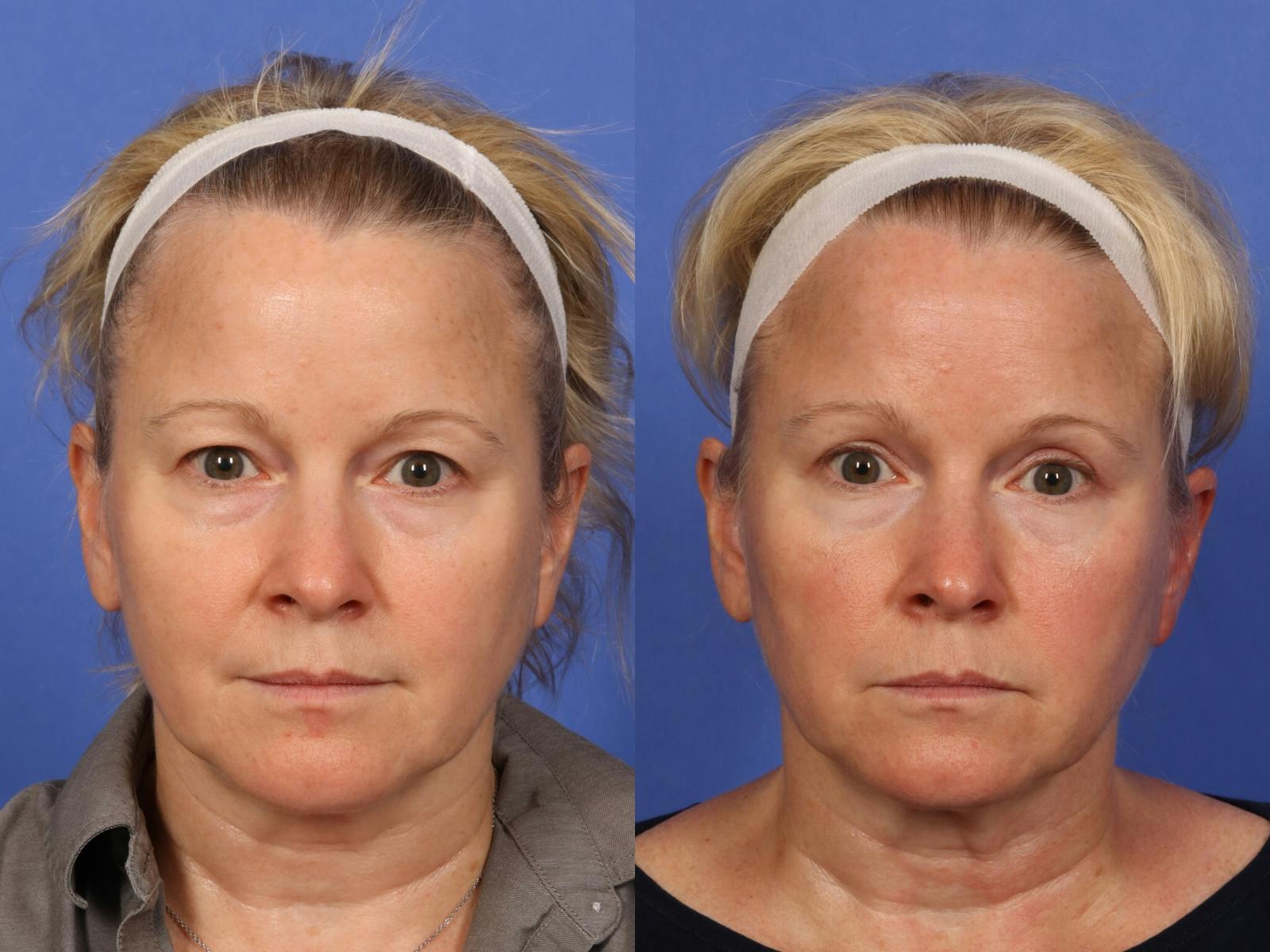 Eyelid Revision Surgery Before & After Gallery - Patient 339004 - Image 1