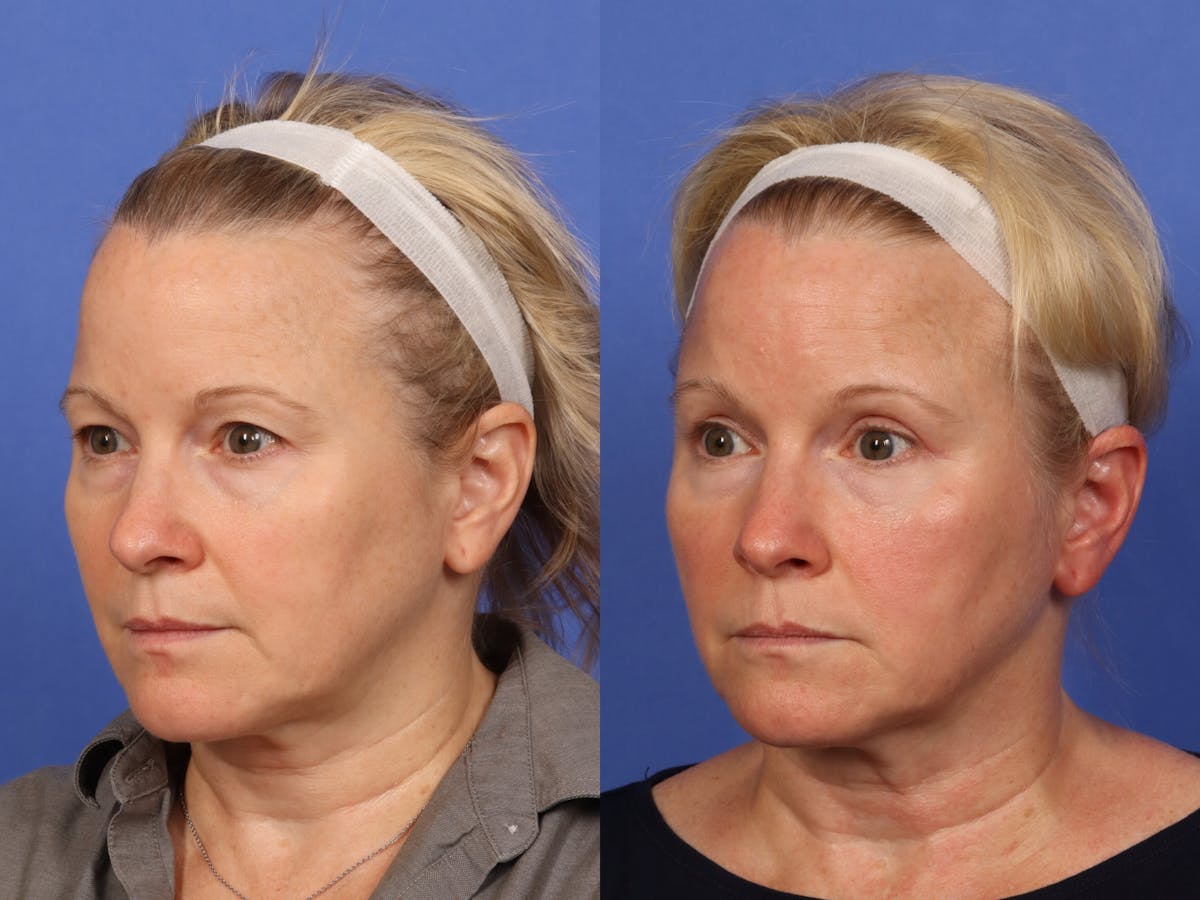 Eyelid Revision Surgery Before & After Gallery - Patient 339004 - Image 3