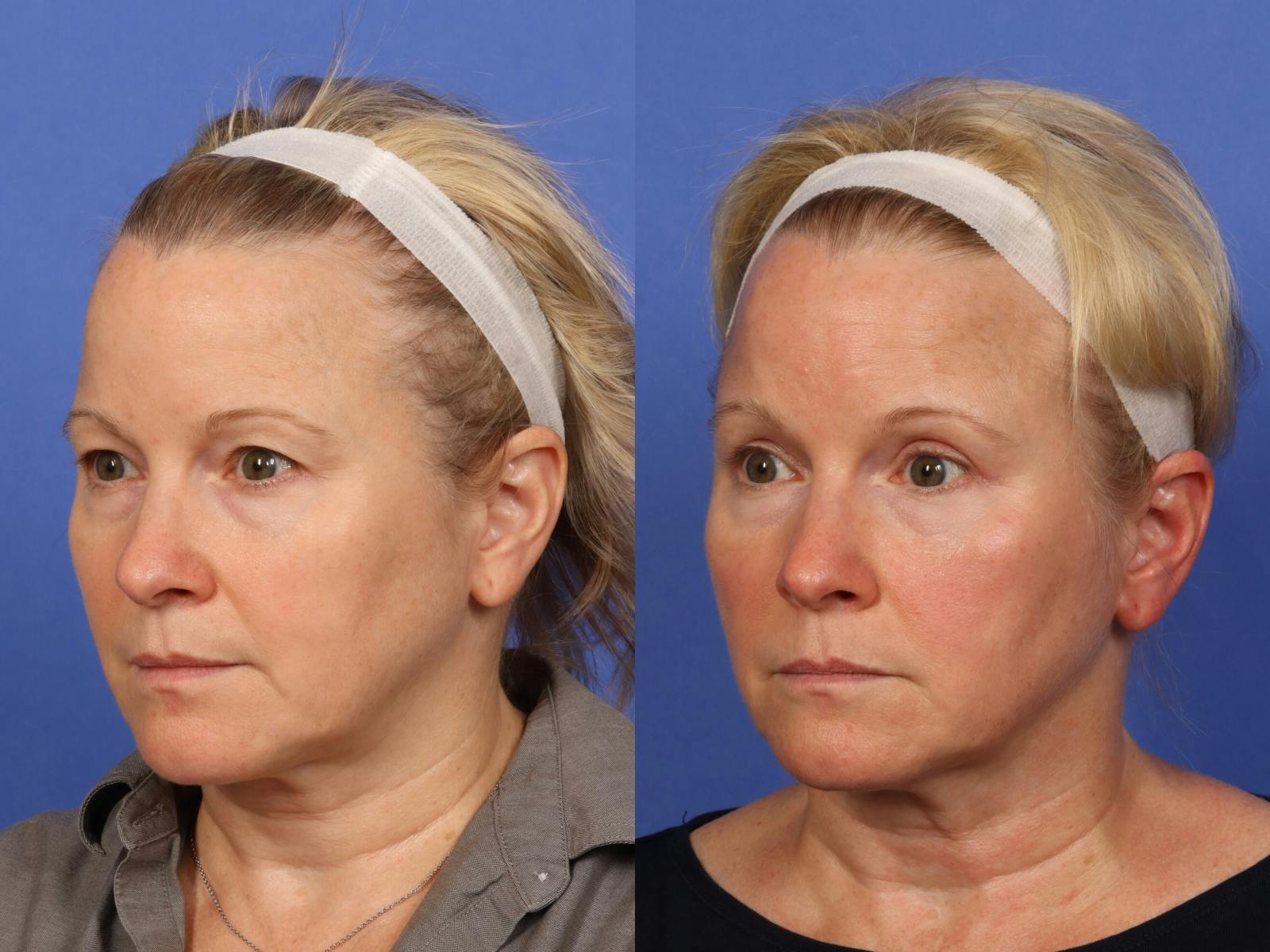 Eyelid Revision Surgery Before & After Gallery - Patient 339004 - Image 3