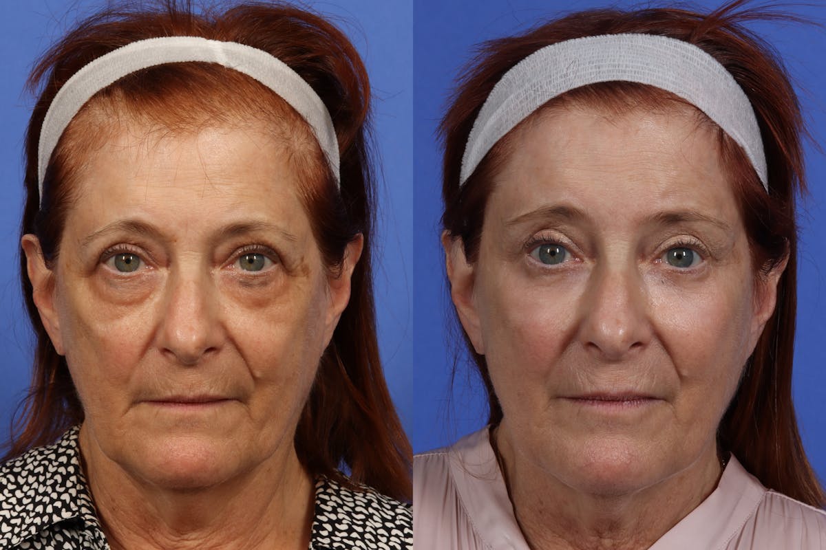 Brow Lift Before & After Gallery - Patient 154825 - Image 1