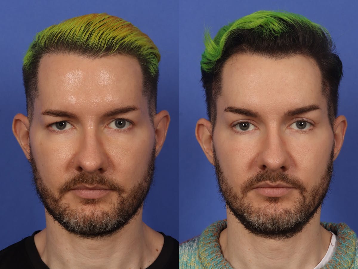 Brow Lift Before & After Gallery - Patient 289125 - Image 1