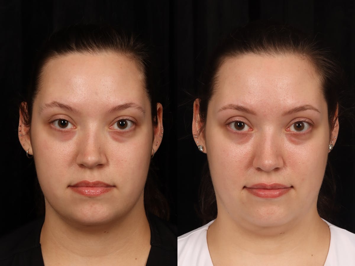 UltraClear™ Laser Before & After Gallery - Patient 395040 - Image 1