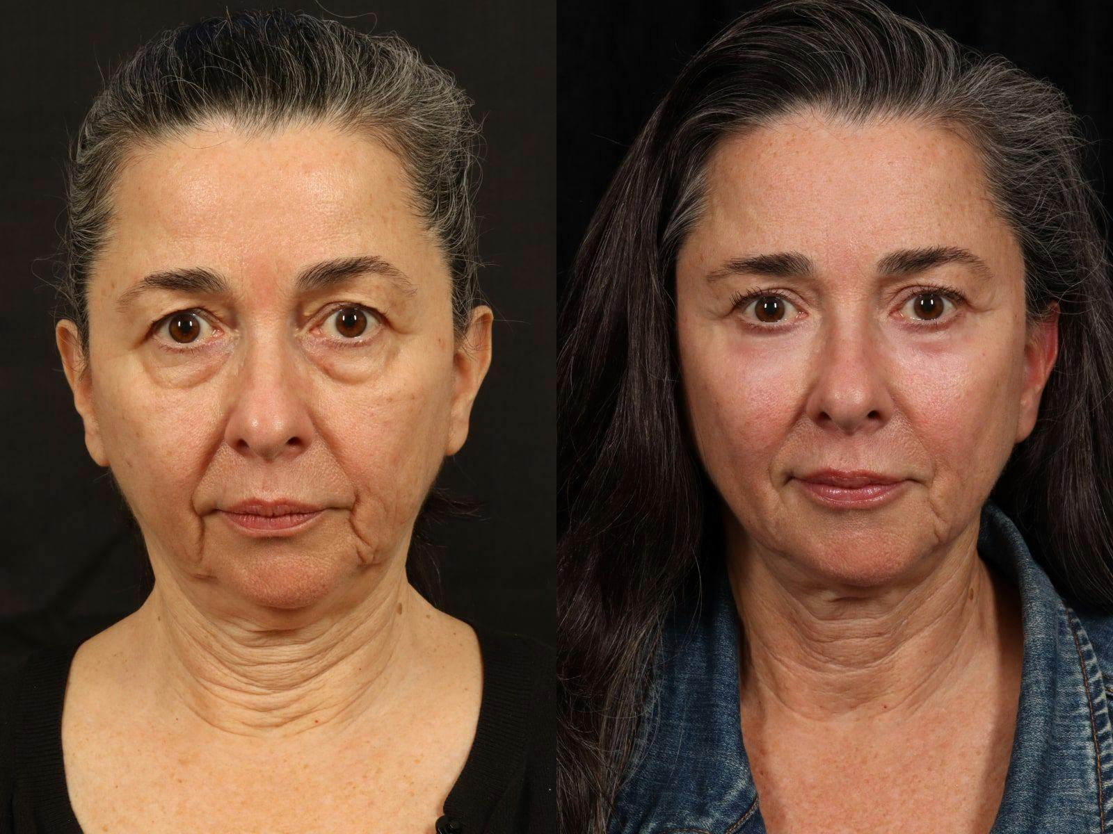 Mid Facelift Before & After Gallery - Patient 156242 - Image 1