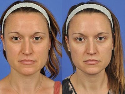 BOTOX® Before & After Gallery - Patient 767007 - Image 1