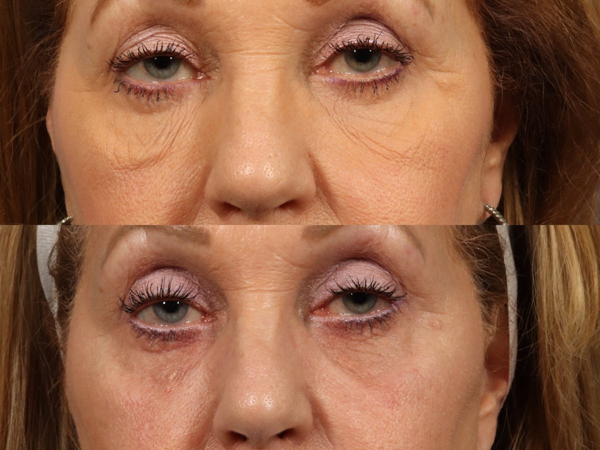 Radiofrequency Microneedling (Morpheus8) Before & After Gallery - Patient 286785 - Image 1