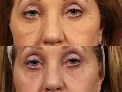 Festoon Surgery Before & After Gallery - Patient 834690 - Image 1