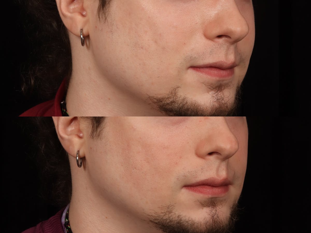 UltraClear™ Laser Before & After Gallery - Patient 264561 - Image 1