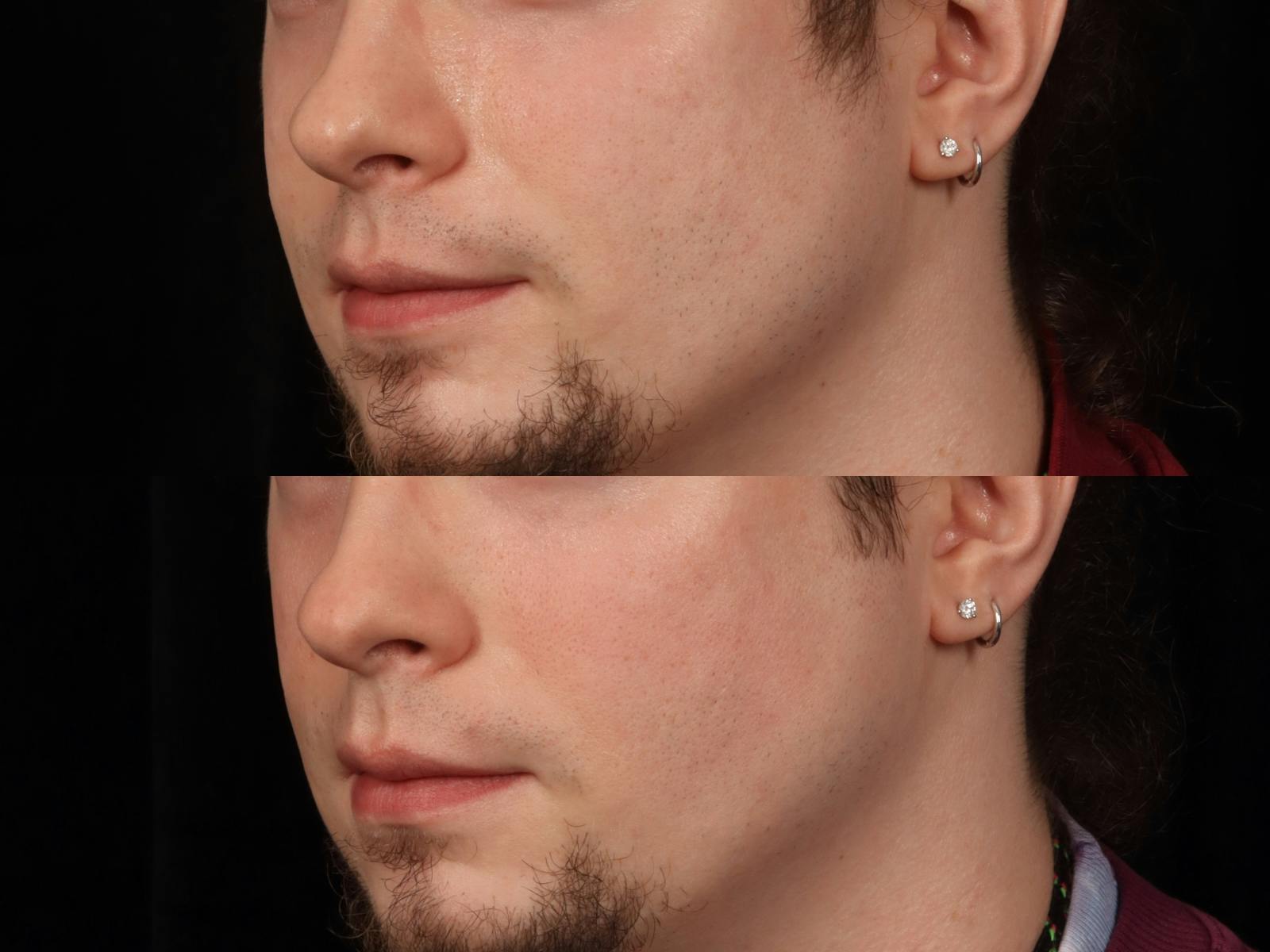 UltraClear™ Laser Before & After Gallery - Patient 264561 - Image 2