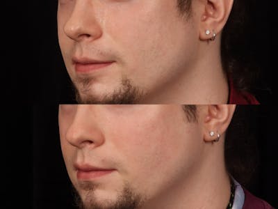 UltraClear™ Laser Before & After Gallery - Patient 264561 - Image 2