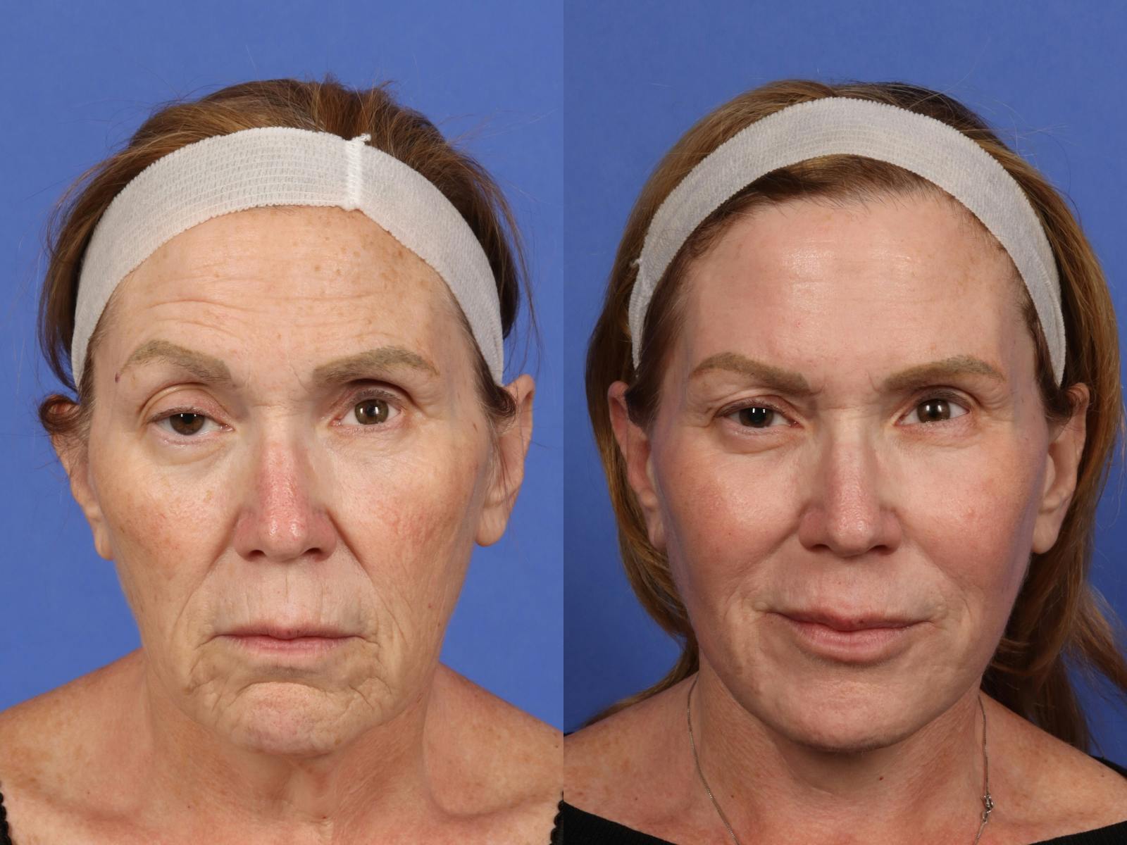 UltraClear™ Laser Before & After Gallery - Patient 223770 - Image 1