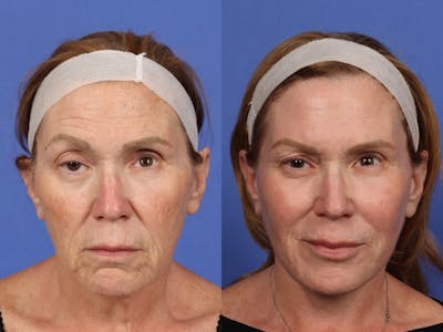 UltraClear™ Laser Before & After Gallery - Patient 223770 - Image 1