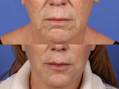 UltraClear™ Laser Before & After Gallery - Patient 223770 - Image 2
