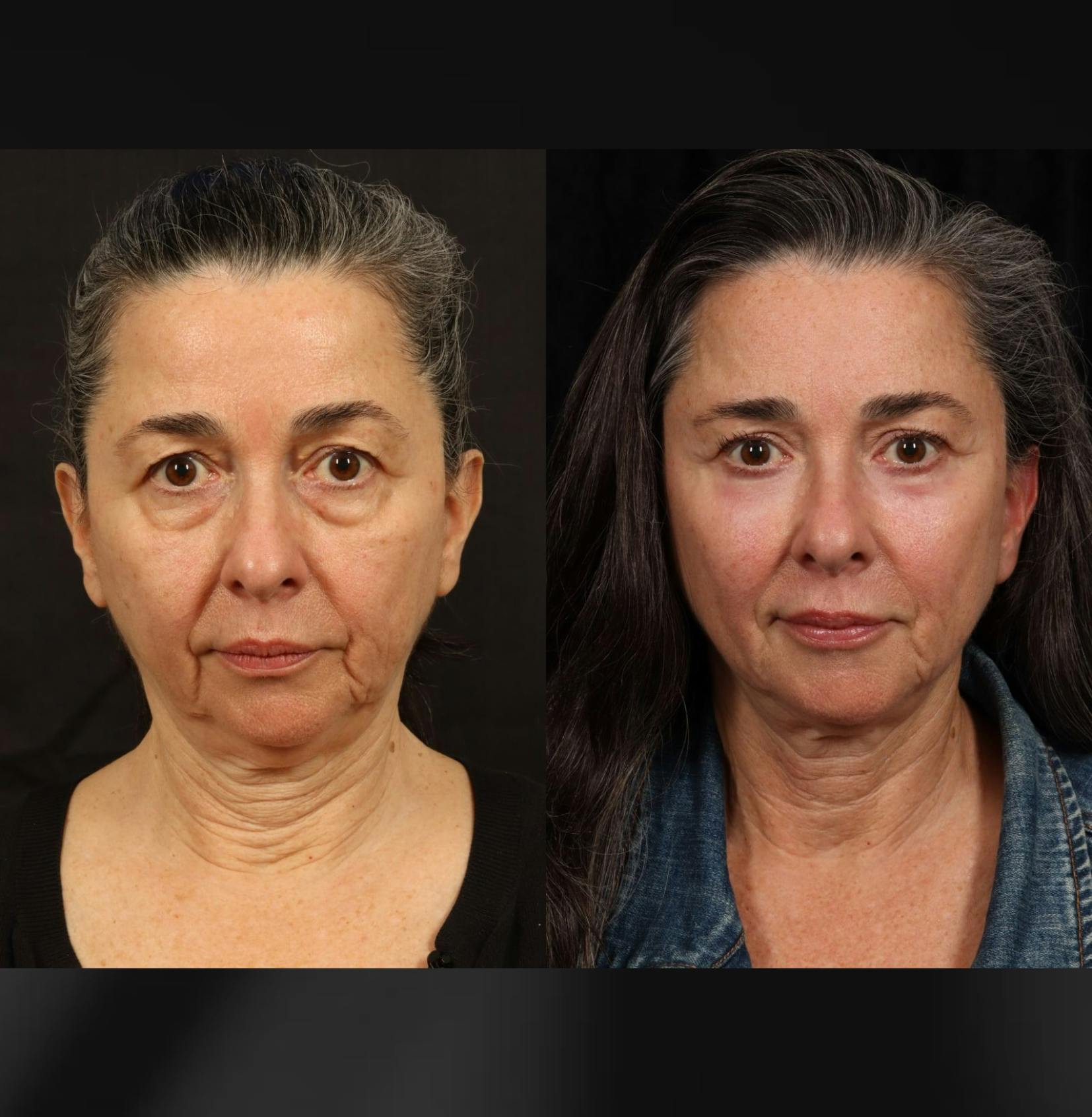 Micromid facelift B&As