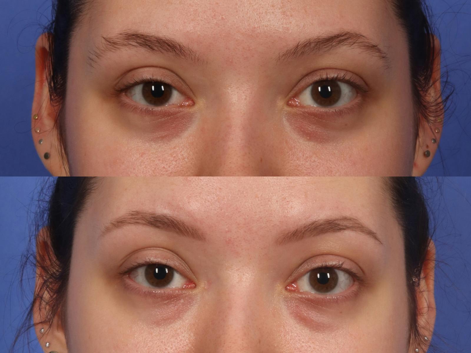 Permanent Makeup Before & After Gallery - Patient 424398 - Image 1