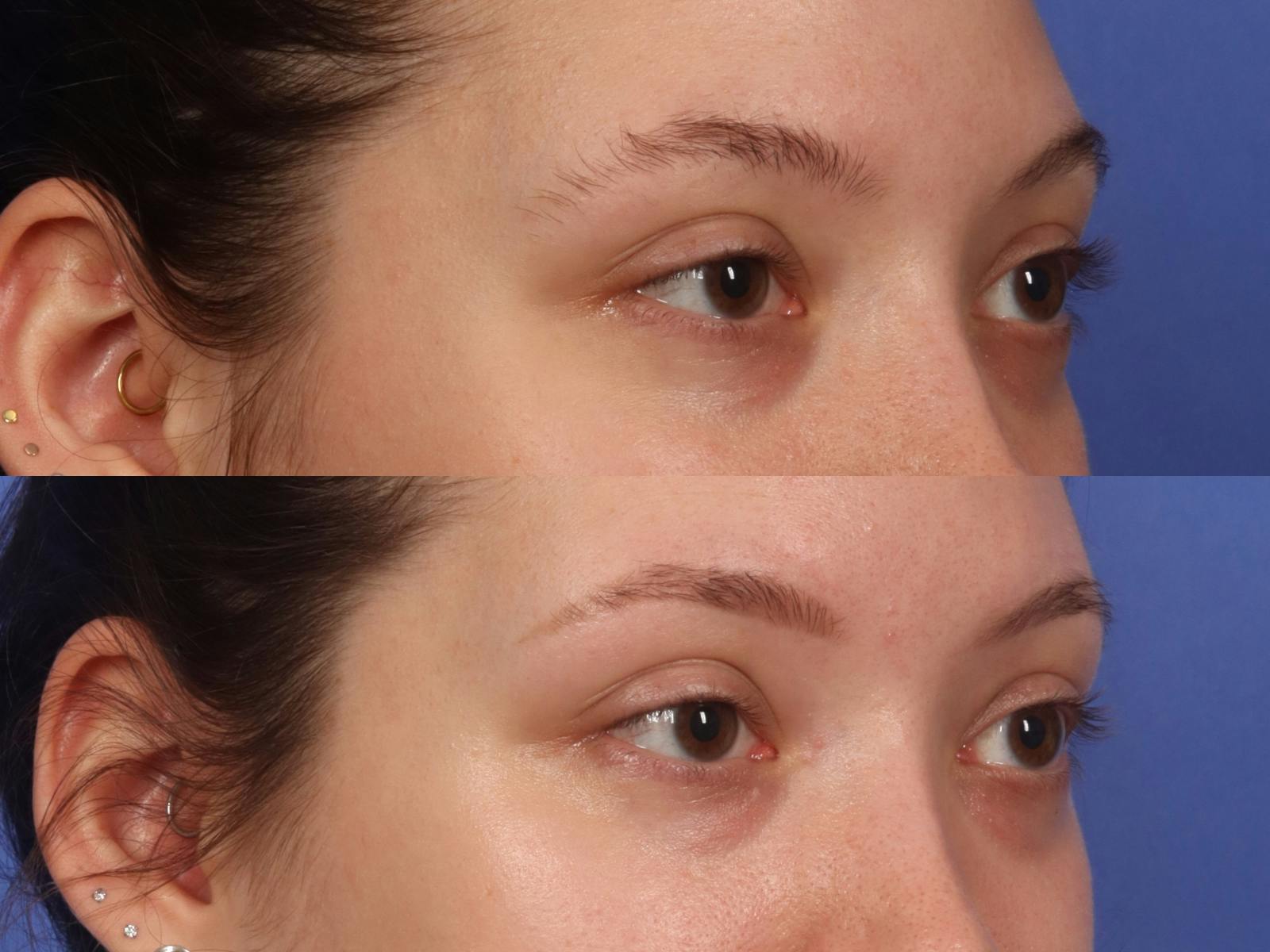 Permanent Makeup Before & After Gallery - Patient 424398 - Image 2