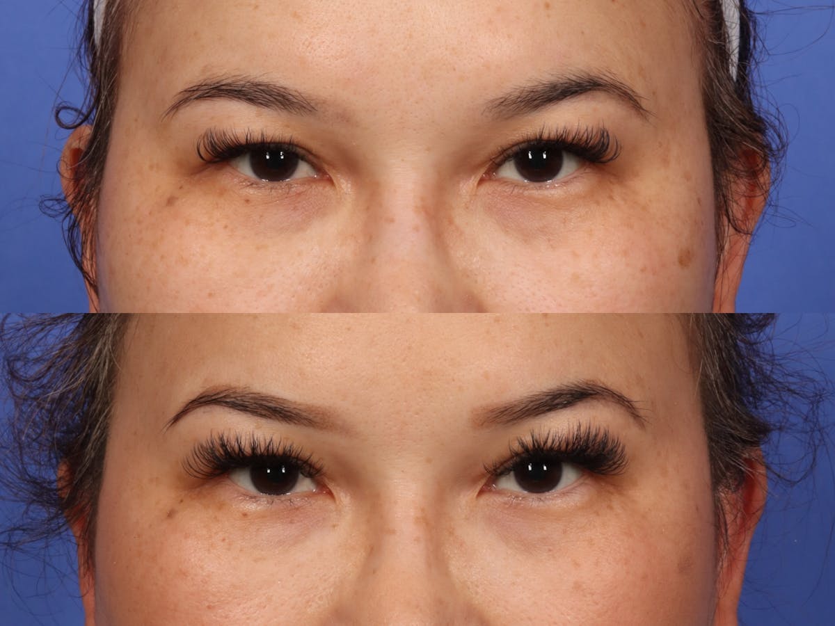 Permanent Makeup Before & After Gallery - Patient 358664 - Image 1