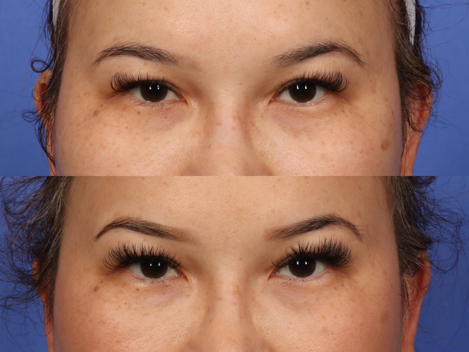 Permanent Makeup Before & After Gallery - Patient 358664 - Image 1