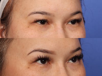 Permanent Makeup Before & After Gallery - Patient 358664 - Image 2