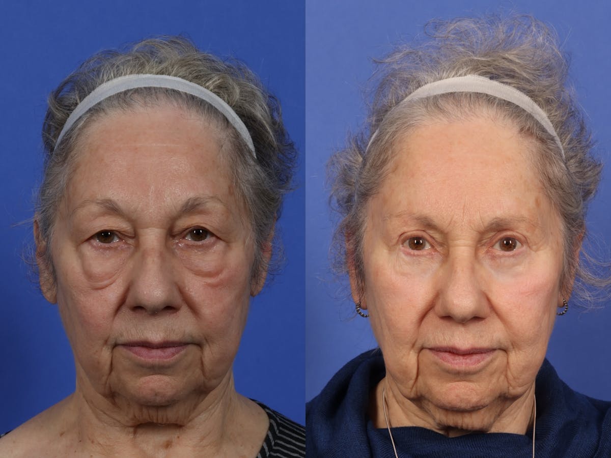 Brow Lift Before & After Gallery - Patient 382194 - Image 1
